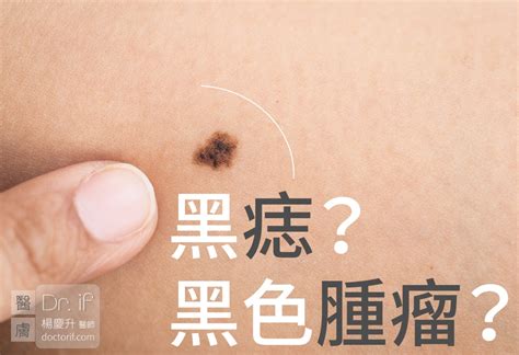 陰囊 痣|陰囊上的痣：正常嗎？該去看皮膚科嗎？